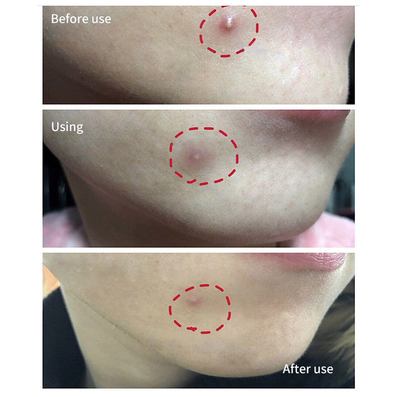Adesivo removedor de acne e espinhas